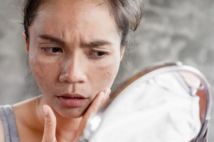 Effective Ways to Remove Black Spots on the Face Naturally